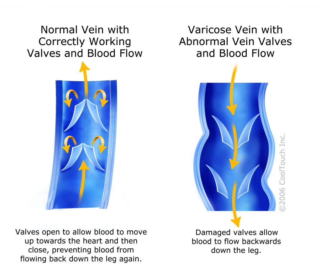 Vein Values Illustration